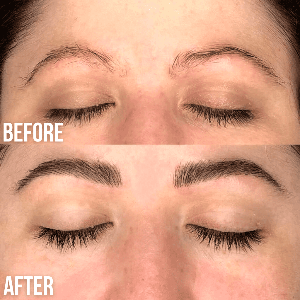 brow lifting