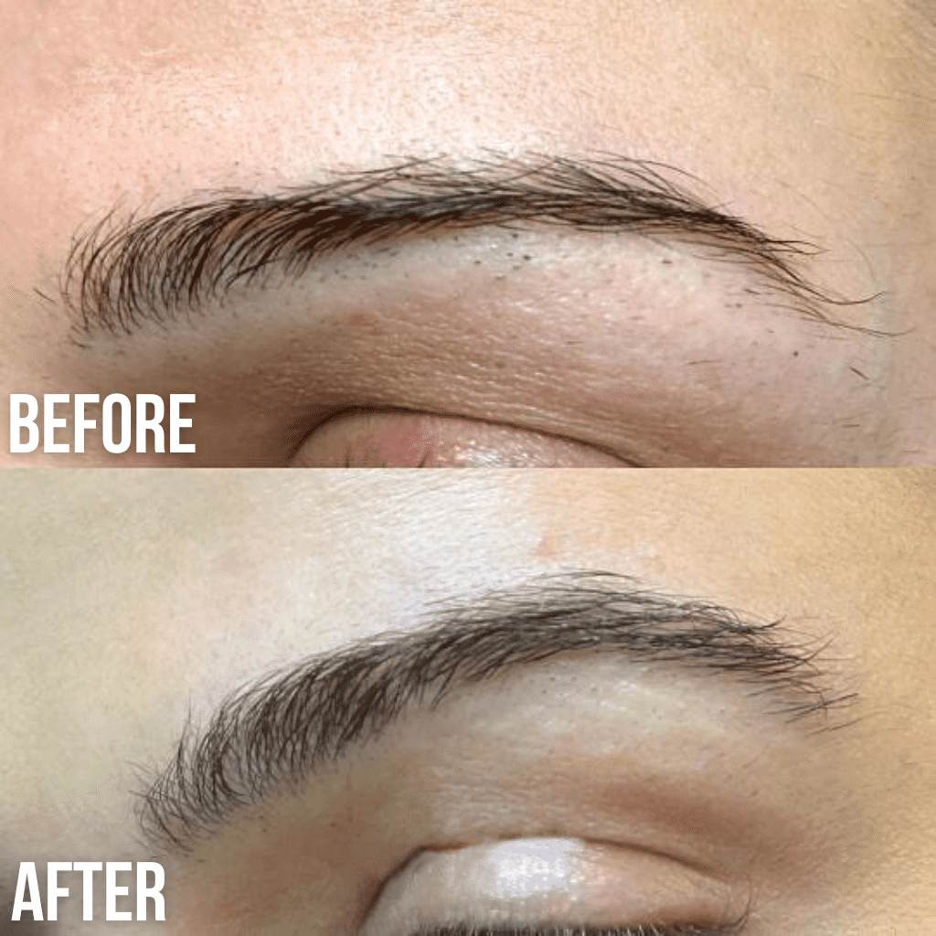 brow lifting